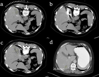 Percutaneous Radiofrequency Ablation Combined With Chemotherapy Versus Chemotherapy Only for Ovarian Cancer Liver Metastasis